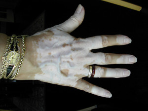 A vitiligo kezelése rendkívül fontos